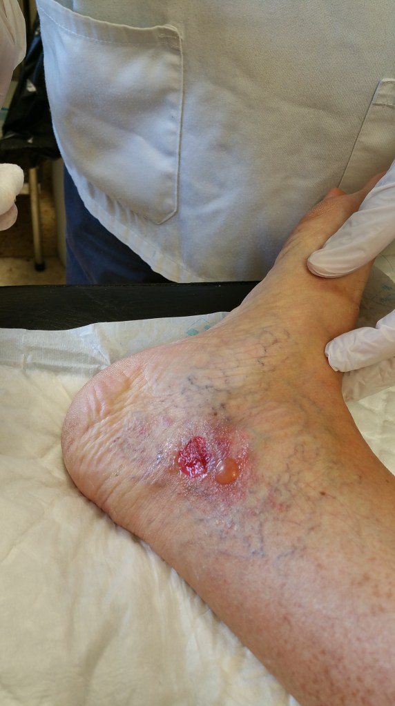 Pupa mala en las curas