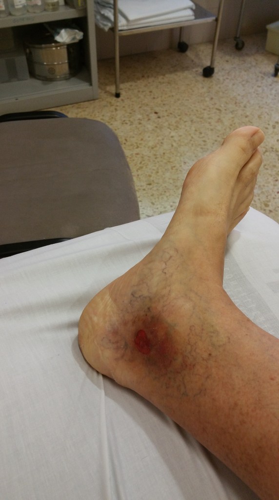 La pupa se fue pero hasta que se cura del todo deja huella